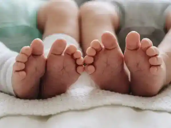 Pascaoperasi Pemisahan, Bayi Kembar Siam di RSCM Mulai Pulih di Ruang Rawat Biasa